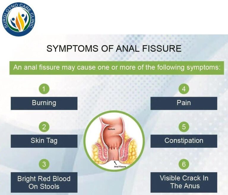 What Signs Of An Anal Fissure Are Present Best Piles Treatment In Agra