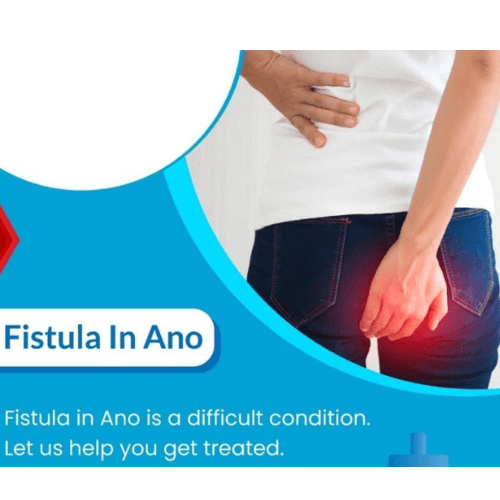 Fistula in Ano