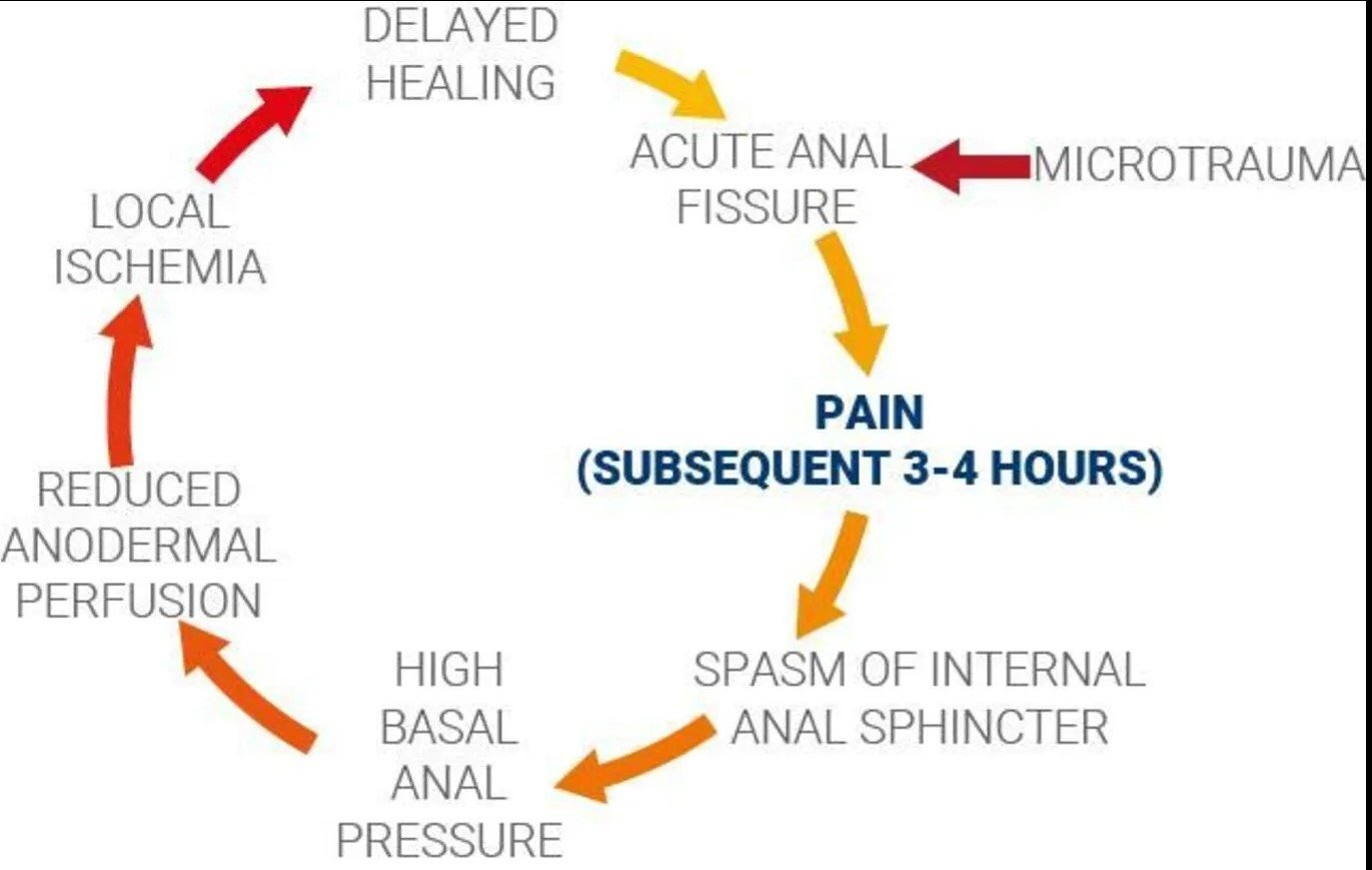 Cycle of Anal Fissure