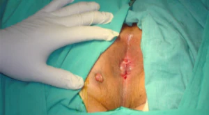 Treatment for Anal Fistula