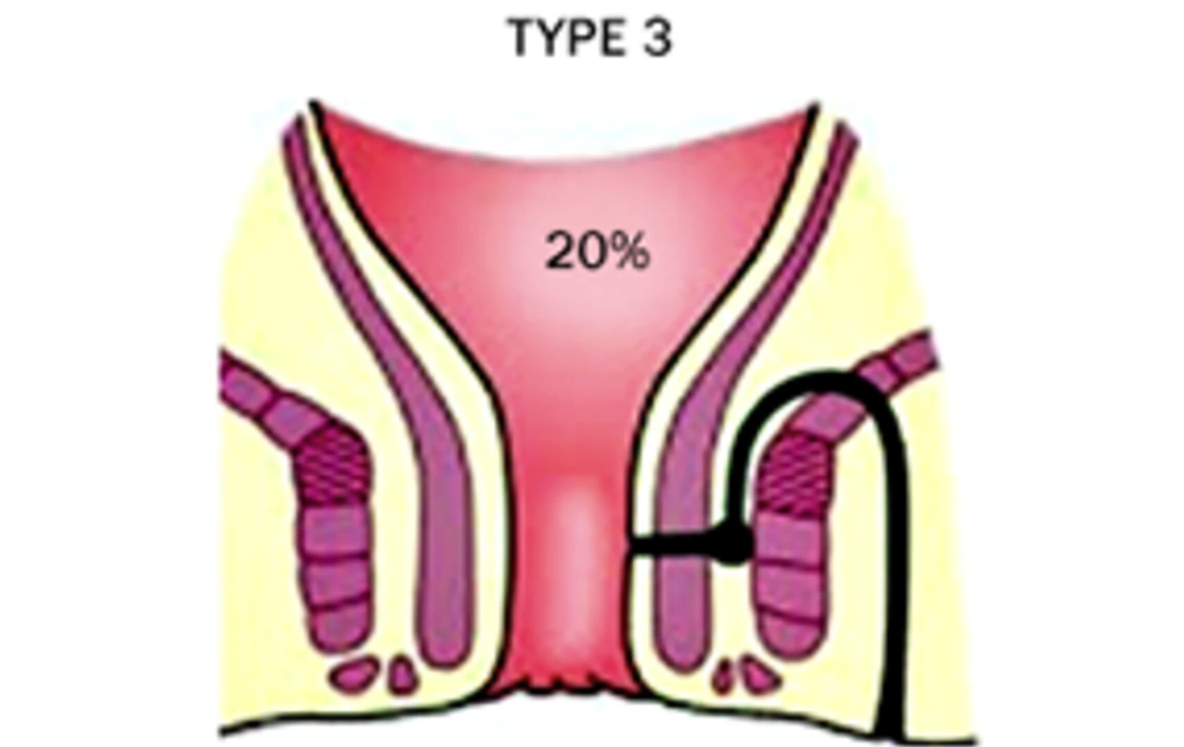 SUPRA-SPHINCTERIC fistula