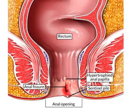 Anal fissure