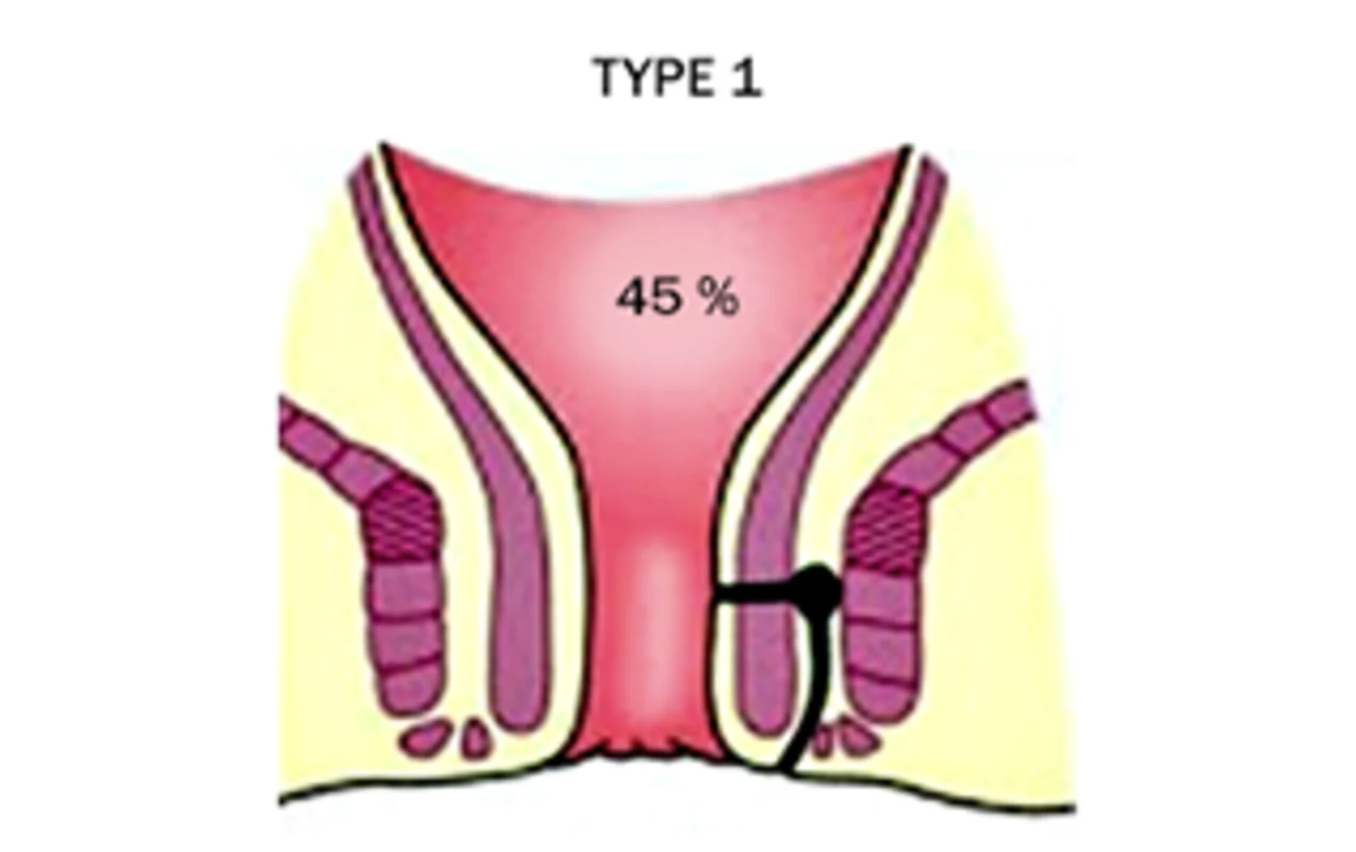 Inter-SPHINCTERIC fistula