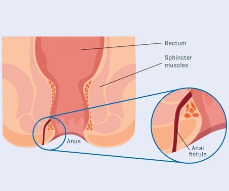 Anal Fistula