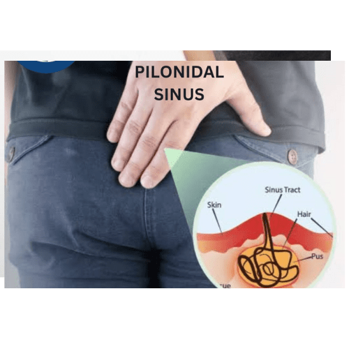 Treatment for Pilonidal Sinus