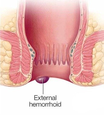 External Hemorrhoid