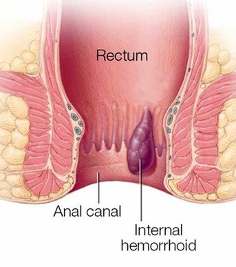 Internal Hemorrhoid