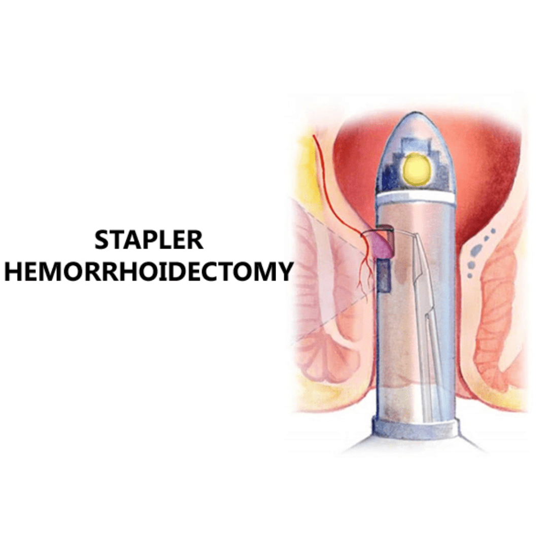 staped-hemorrhoidectomy