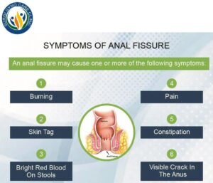 symptoms of anal fissure