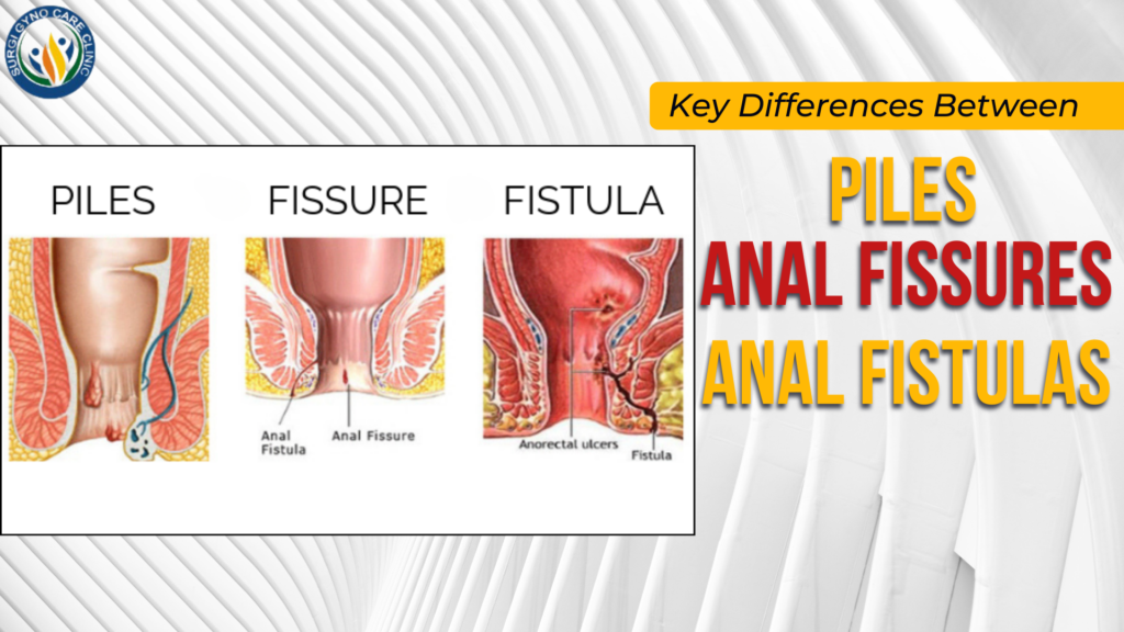 difference between piles, fissure and fistula, piles specialist in agra, fissure doctor near me, fistula doctor near me, laser piles treatment