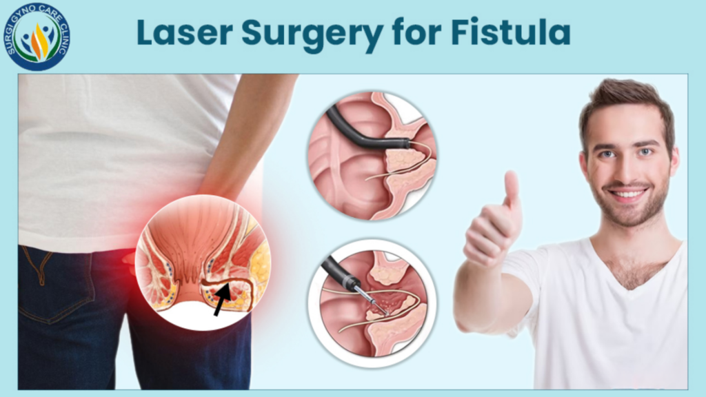 laser fistula surgery in agra